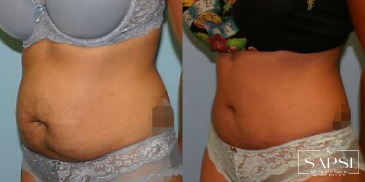 Tummy Tuck: Patient 41 - Before and After 2