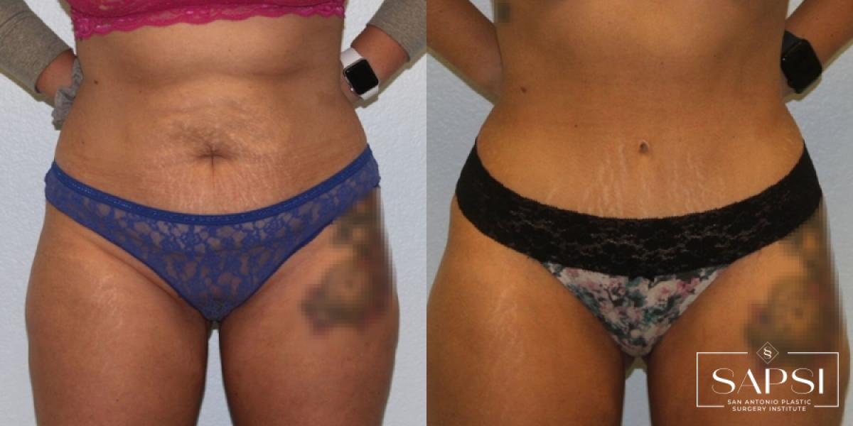 Tummy Tuck: Patient 10 - Before and After  