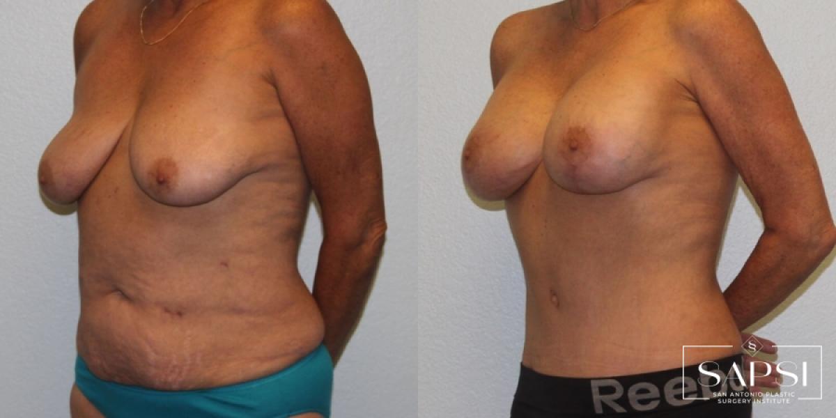 Breast Lift: Patient 8 - Before and After 2