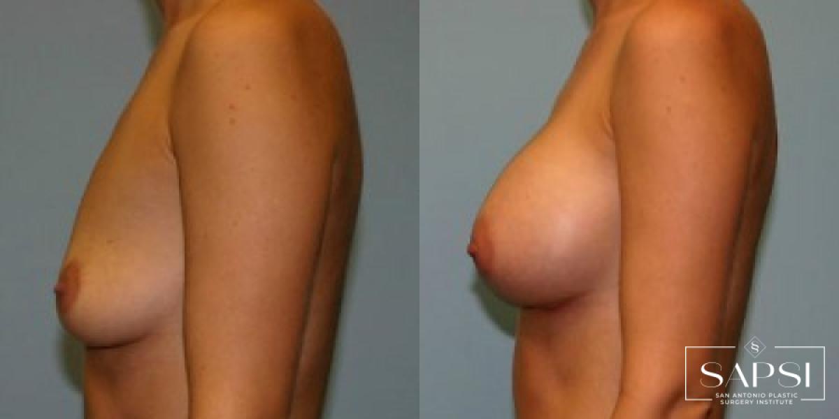 Breast Augmentation: Patient 1 - Before and After 3