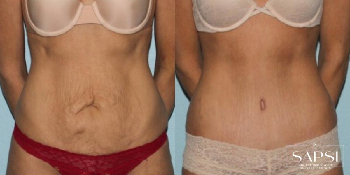 Tummy Tuck: Patient 28 - Before and After 1