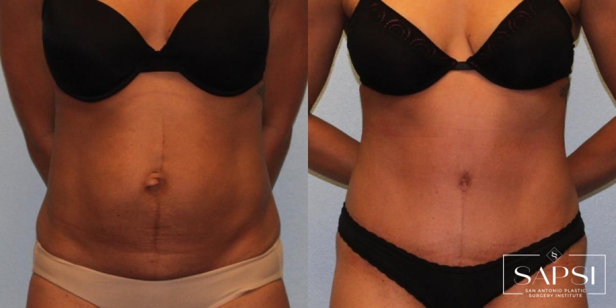 Tummy Tuck: Patient 49 - Before and After 1