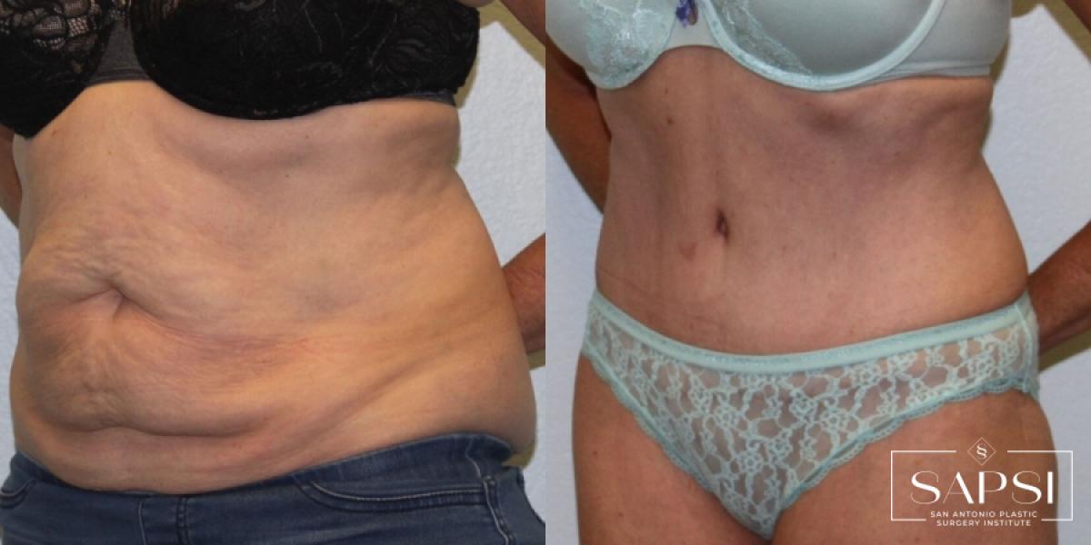 Tummy Tuck: Patient 16 - Before and After 2