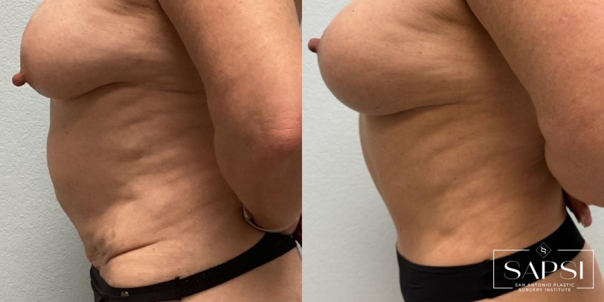 Tummy Tuck: Patient 8 - Before and After 3