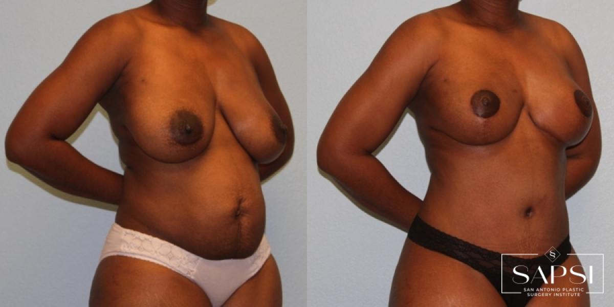 Breast Reduction: Patient 4 - Before and After 2