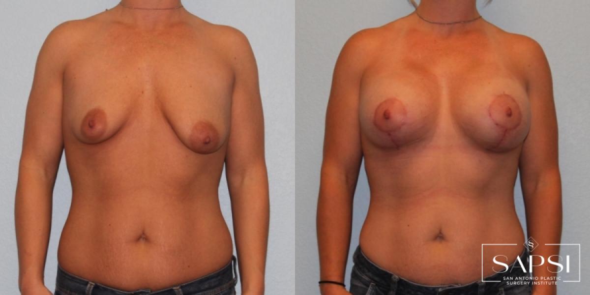 Breast Augmentation With Lift: Patient 11 - Before and After 1