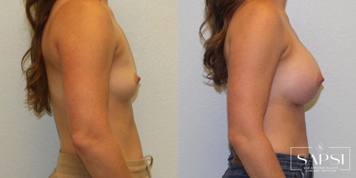 Breast Augmentation: Patient 60 - Before and After 2