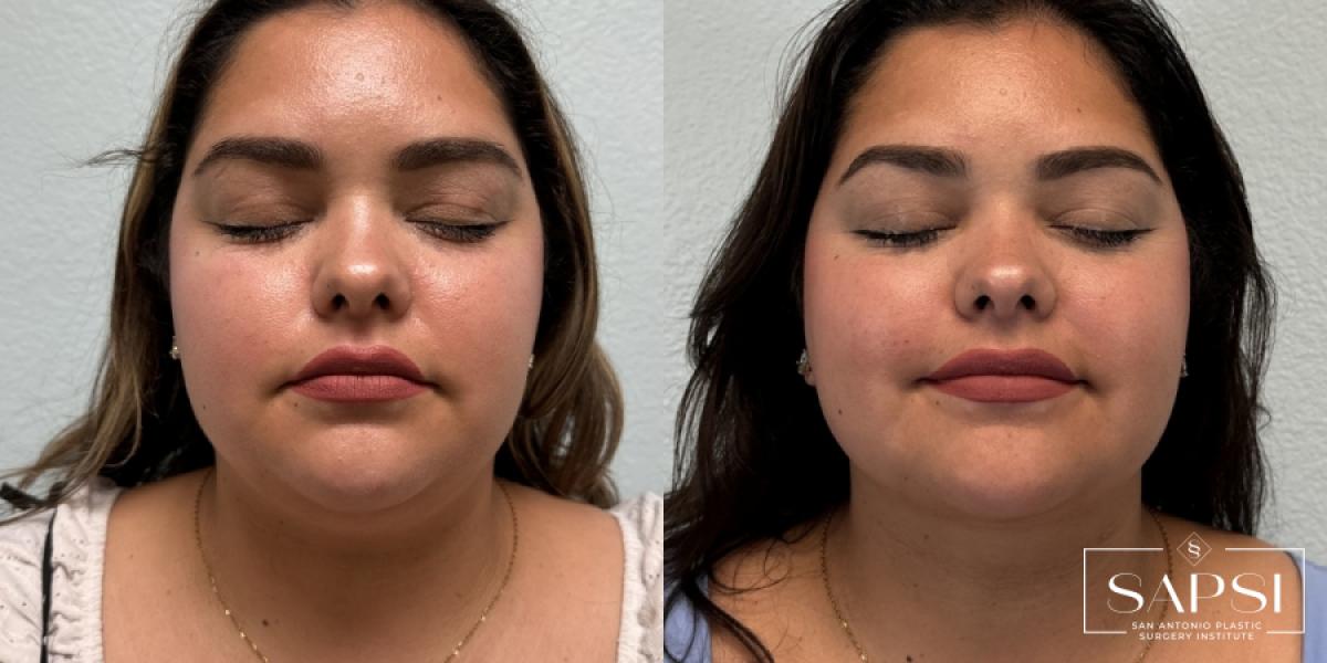 Liposuction: Patient 1 - Before and After  