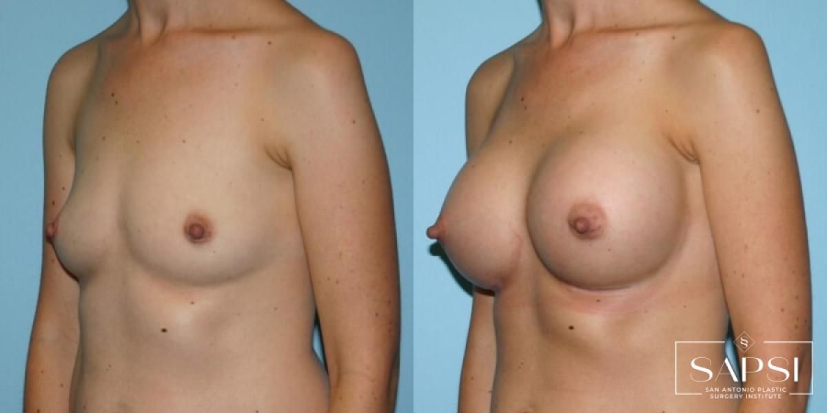 Breast Augmentation: Patient 6 - Before and After 2