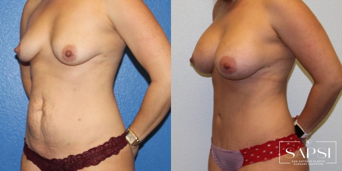 Tummy Tuck: Patient 36 - Before and After 2