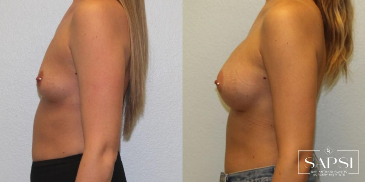 Breast Augmentation: Patient 32 - Before and After 3