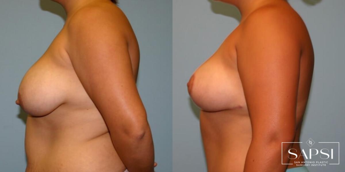 Breast Lift: Patient 17 - Before and After 3