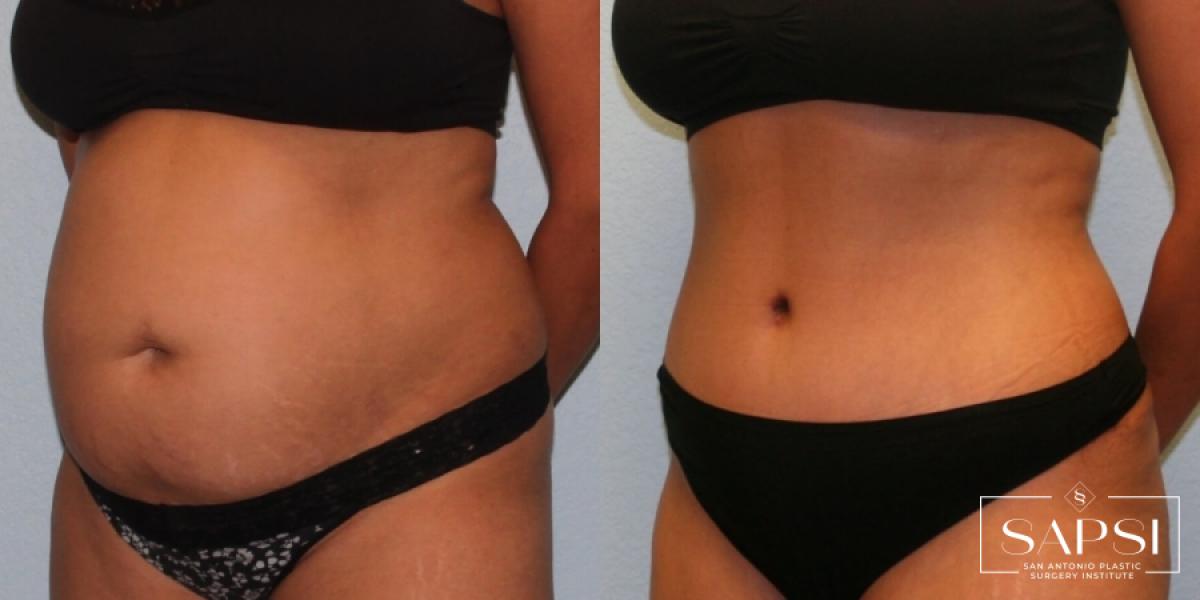 Tummy Tuck: Patient 15 - Before and After 2