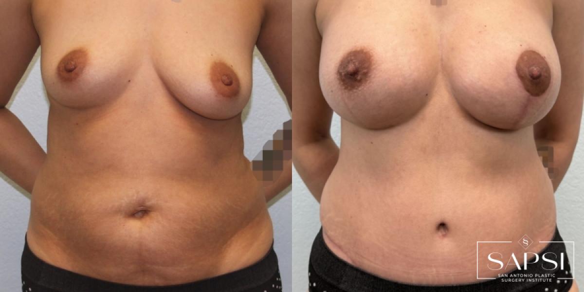 Tummy Tuck: Patient 6 - Before and After  