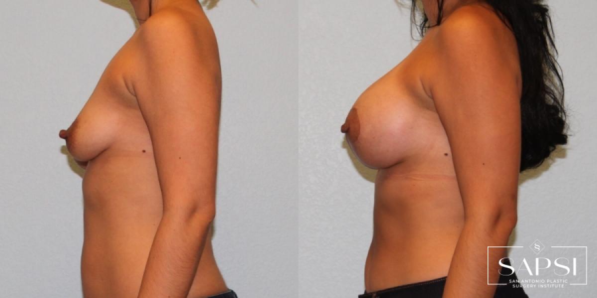 Breast Augmentation With Lift: Patient 10 - Before and After 3