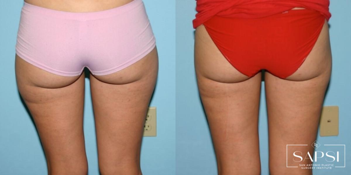 Liposuction: Patient 11 - Before and After 2