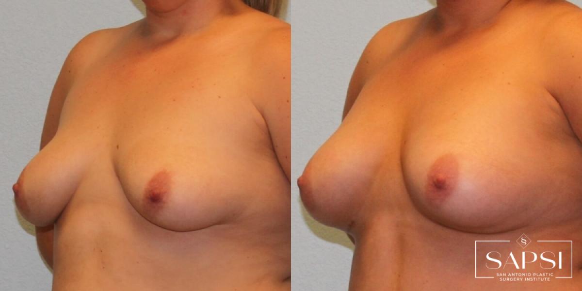 Breast Augmentation: Patient 76 - Before and After 2