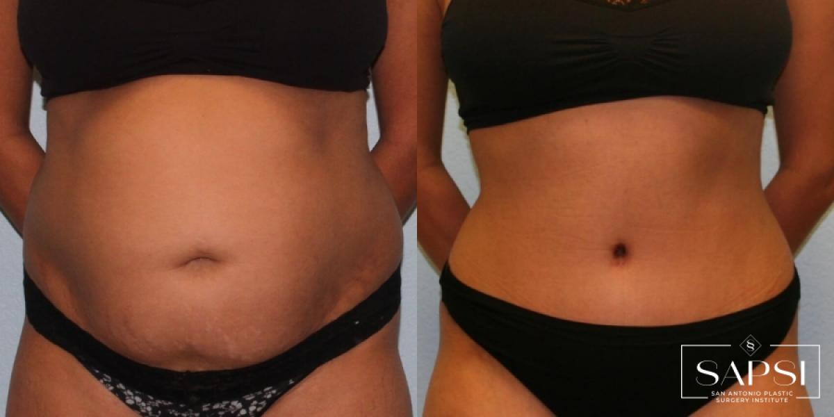 Tummy Tuck: Patient 15 - Before and After 1