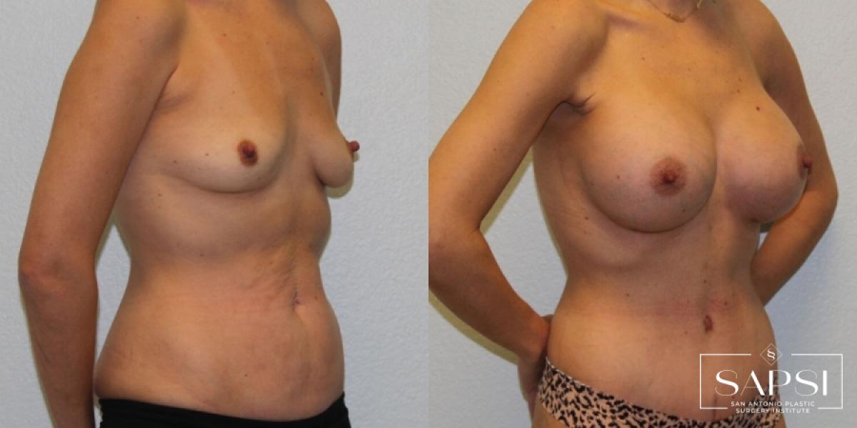 Breast Augmentation: Patient 52 - Before and After 2