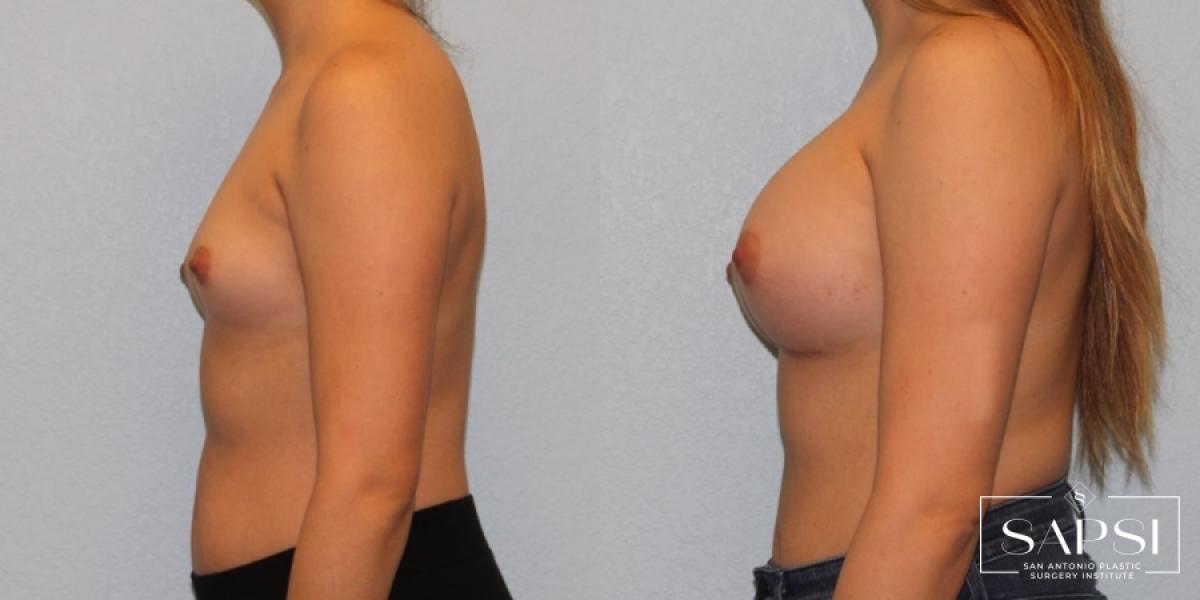 Breast Augmentation: Patient 35 - Before and After 3