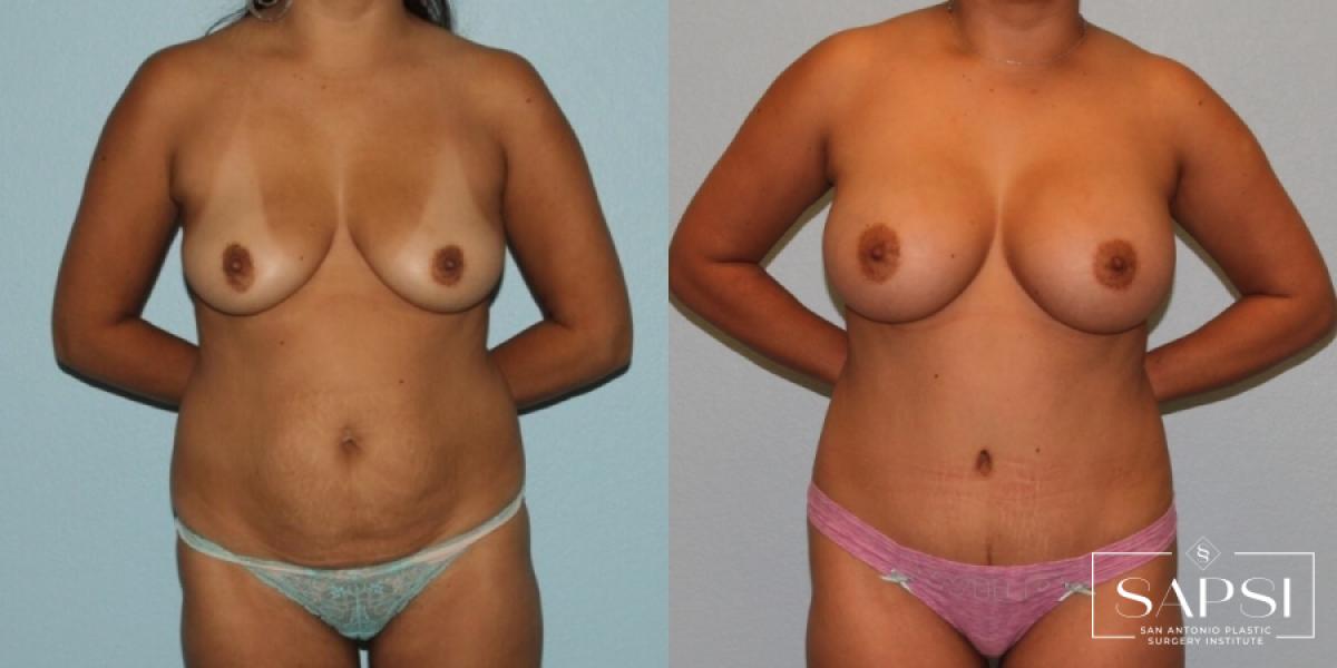 Breast Augmentation: Patient 70 - Before and After 1