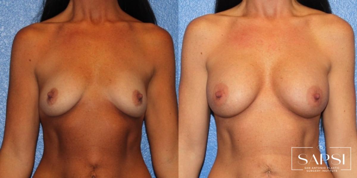 Breast Augmentation: Patient 35 - Before and After 