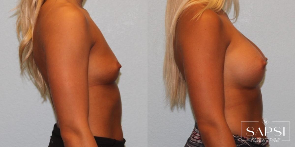 Breast Augmentation: Patient 22 - Before and After 3