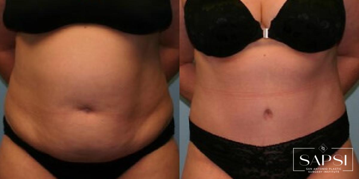 Tummy Tuck: Patient 42 - Before and After 1