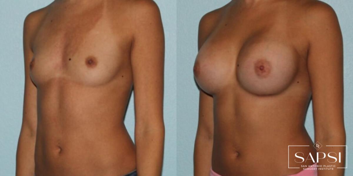 Breast Augmentation: Patient 39 - Before and After 2