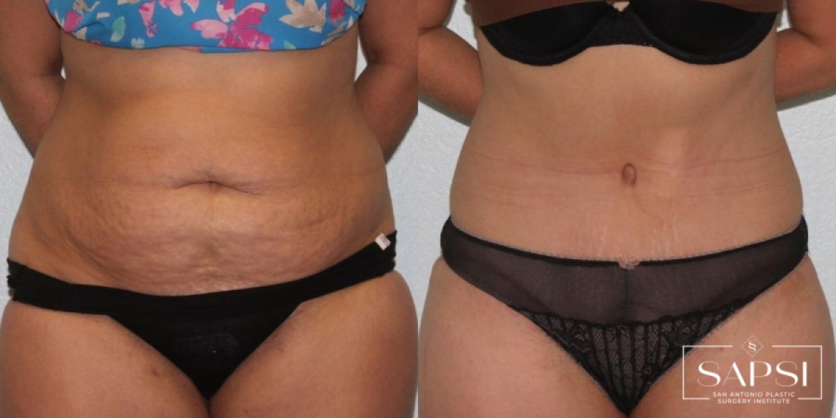 Tummy Tuck: Patient 19 - Before and After 1