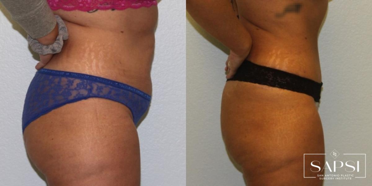 Tummy Tuck: Patient 10 - Before and After 2