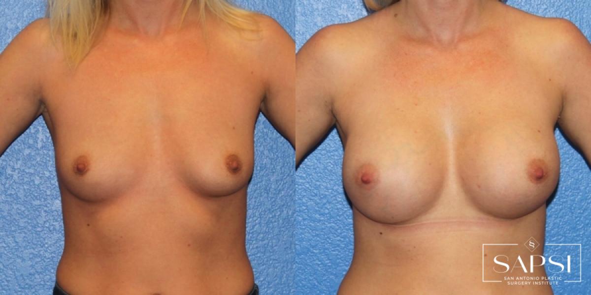 Breast Augmentation: Patient 21 - Before and After 