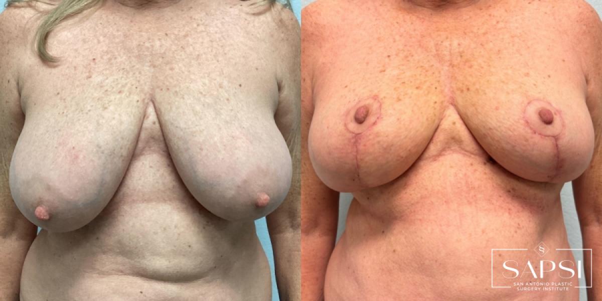 Breast Reduction: Patient 1 - Before and After  