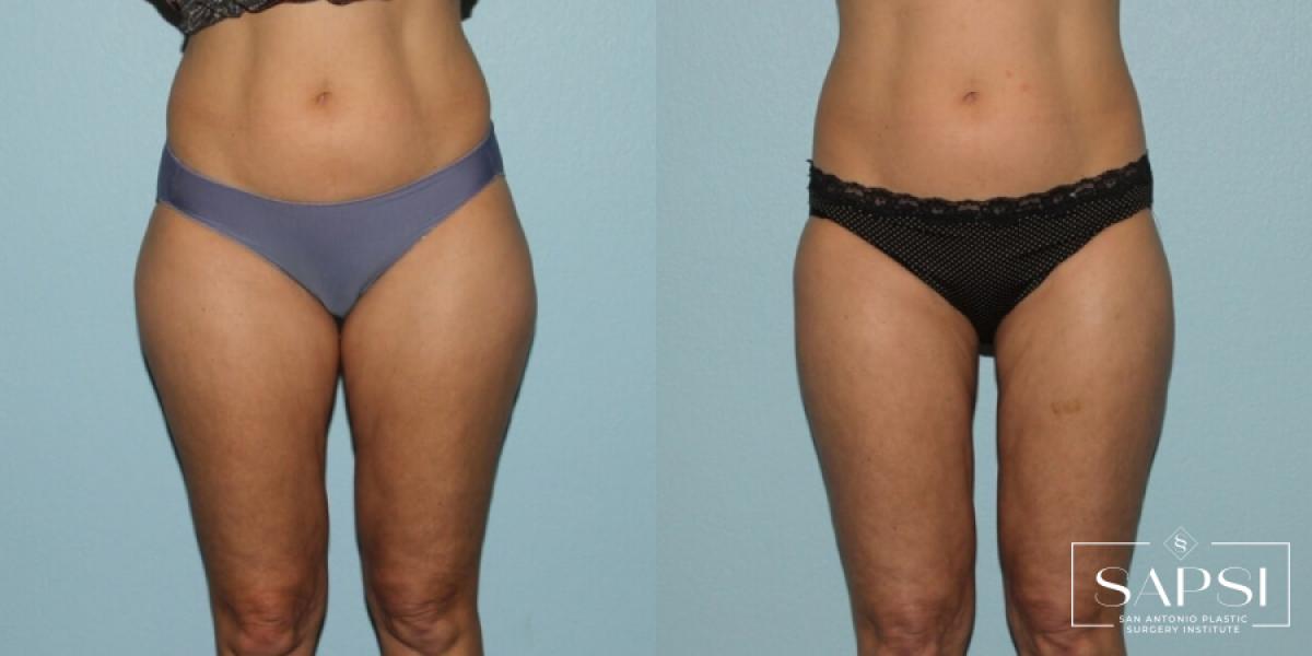 Liposuction: Patient 8 - Before and After  