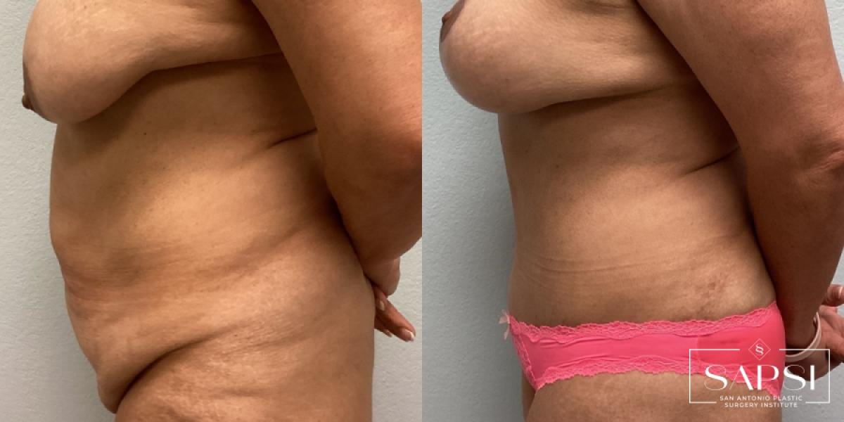 Tummy Tuck: Patient 7 - Before and After 3