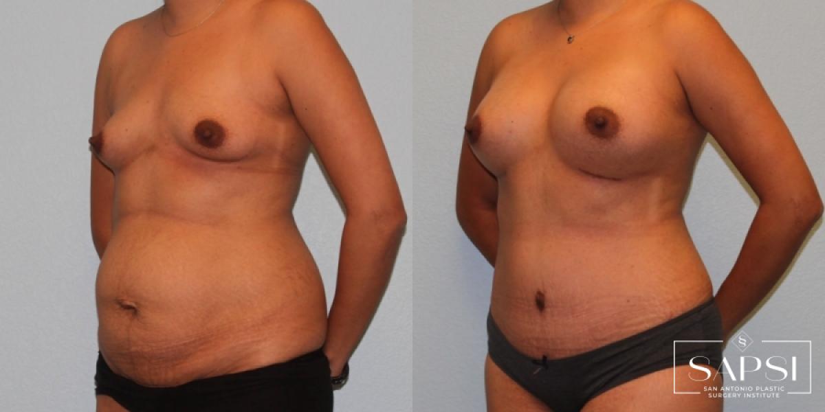 Tummy Tuck: Patient 47 - Before and After 2