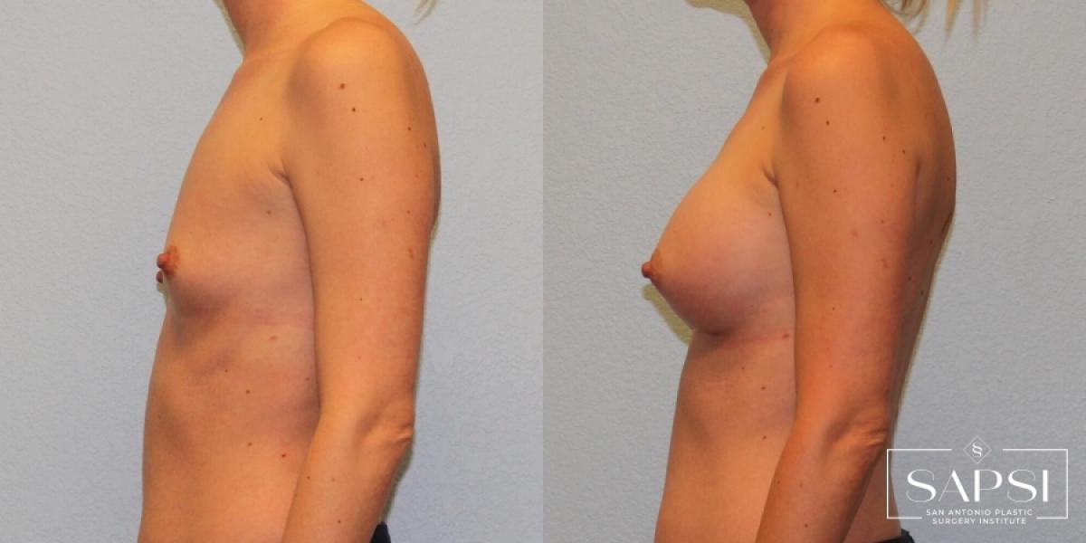 Breast Augmentation: Patient 23 - Before and After 3