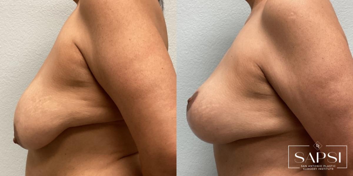 Breast Lift: Patient 19 - Before and After 3