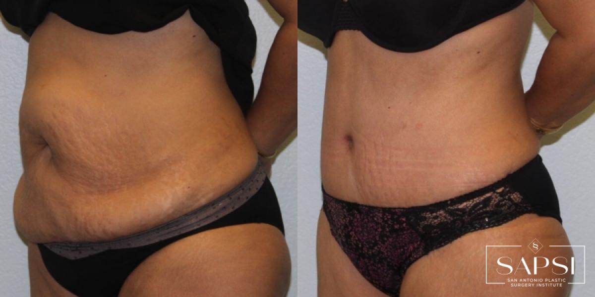 Tummy Tuck: Patient 24 - Before and After 2