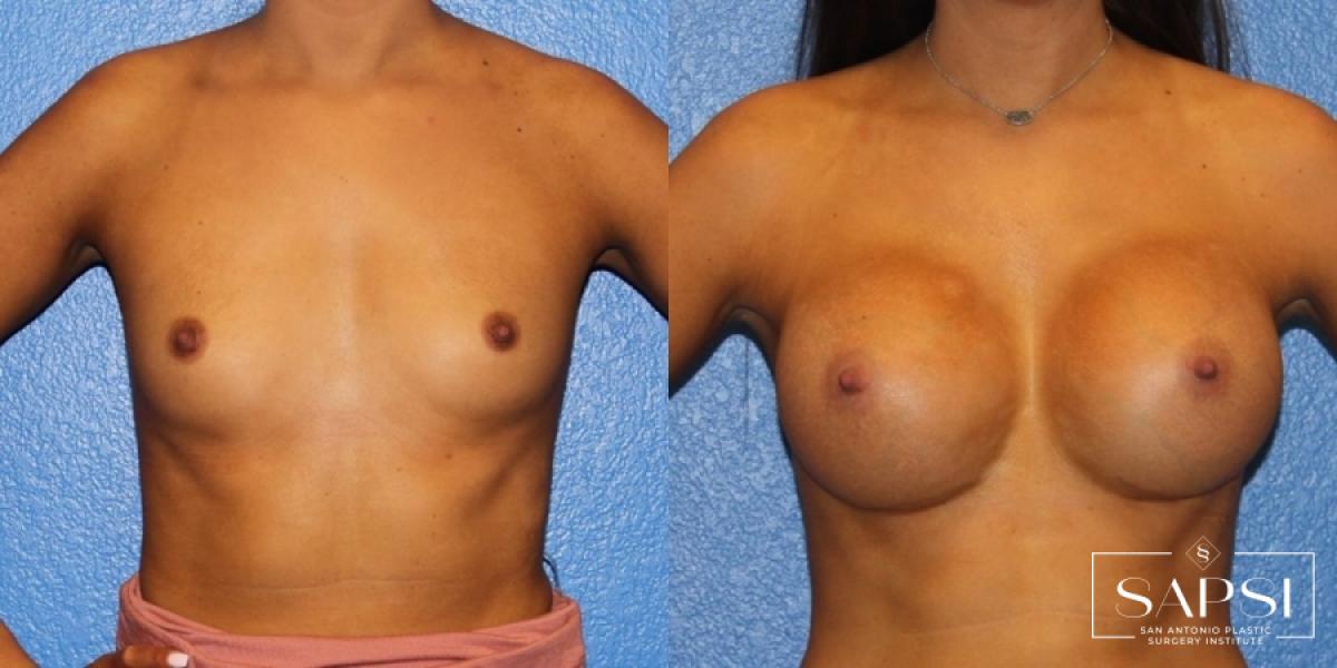 Breast Augmentation: Patient 36 - Before and After 1