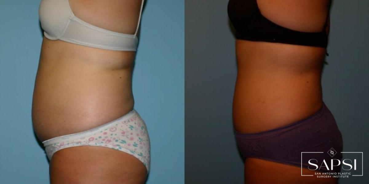 Liposuction: Patient 9 - Before and After 2