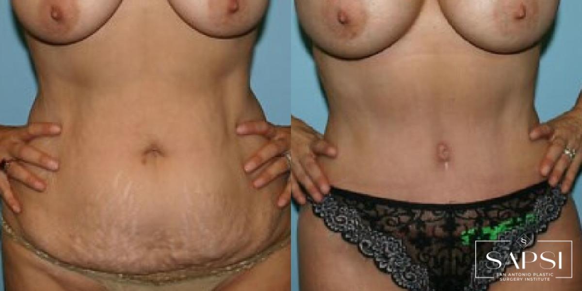 Tummy Tuck: Patient 43 - Before and After 1