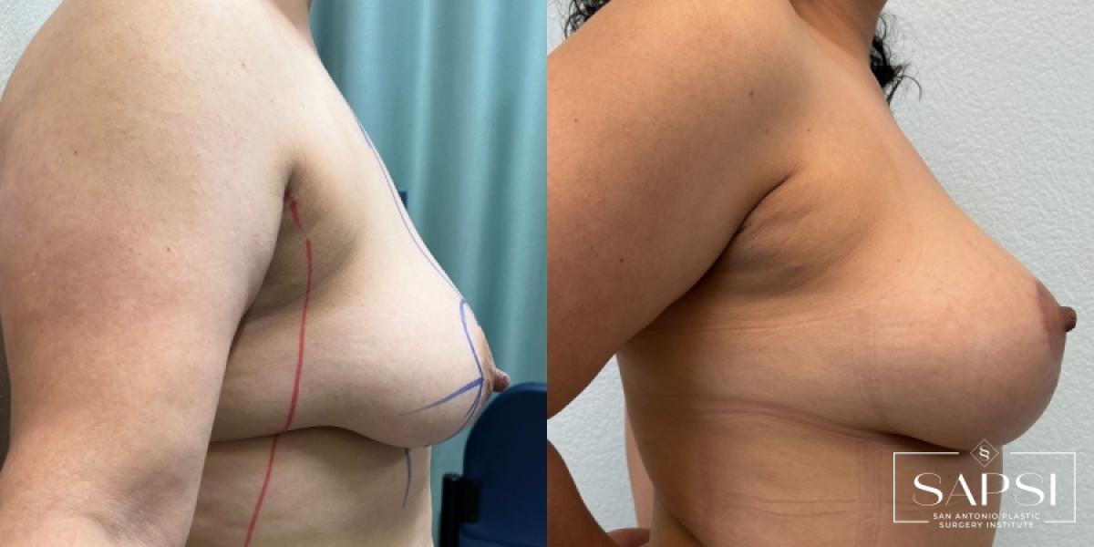 Breast Augmentation With Lift: Patient 23 - Before and After 3