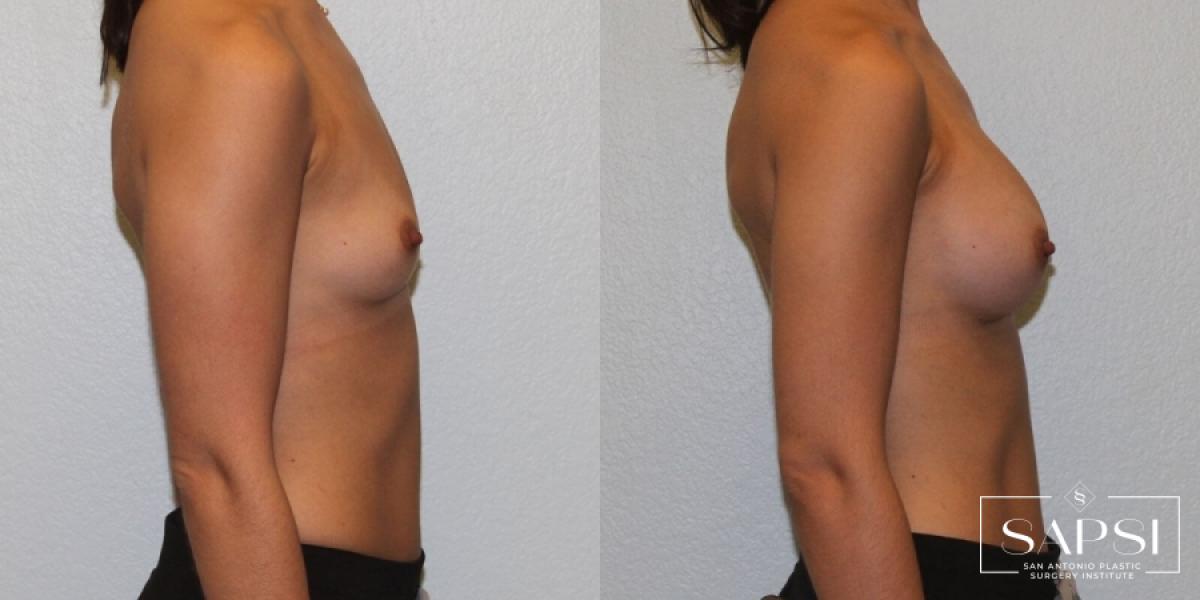 Breast Augmentation: Patient 27 - Before and After 3