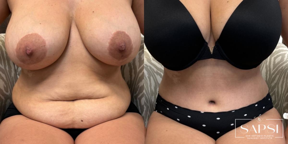 Tummy Tuck: Patient 2 - Before and After 4