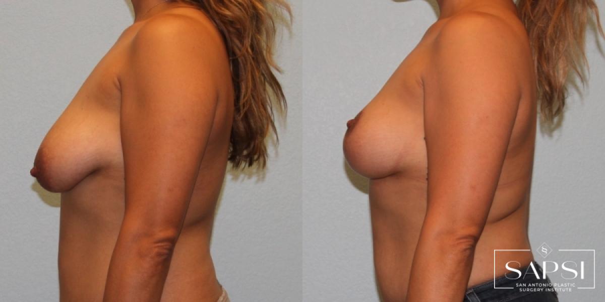 Breast Lift: Patient 14 - Before and After 3