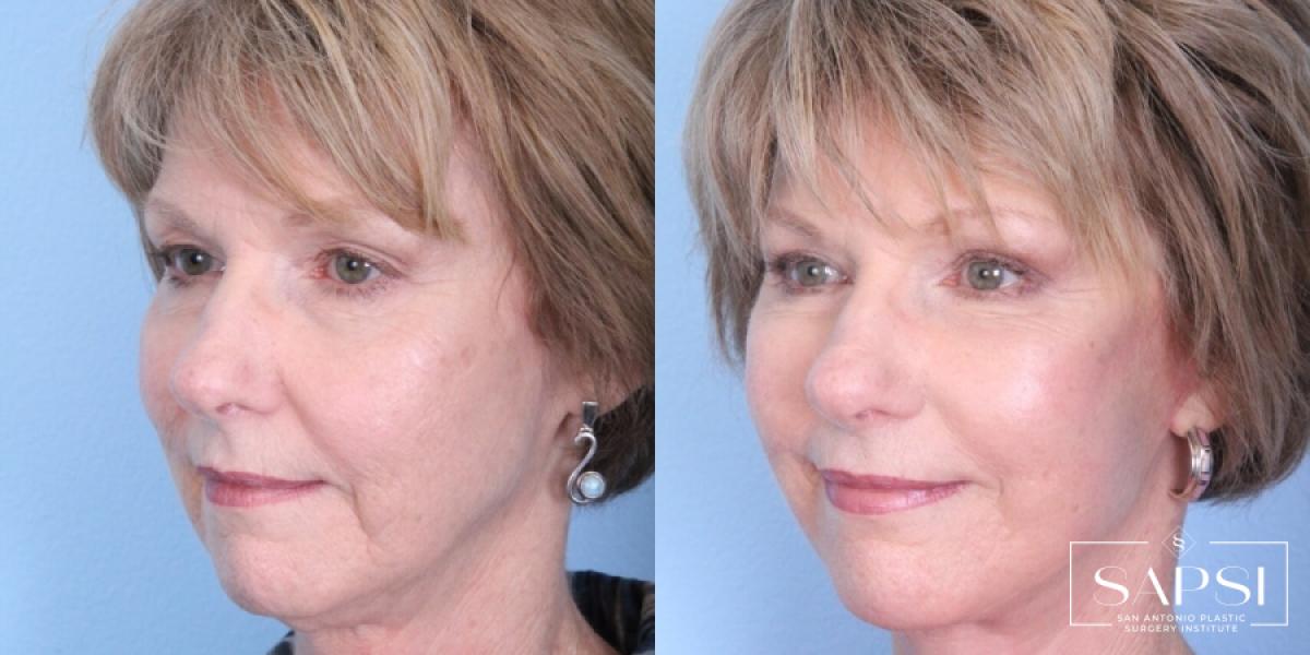 Eyelid Surgery: Patient 2 - Before and After 2