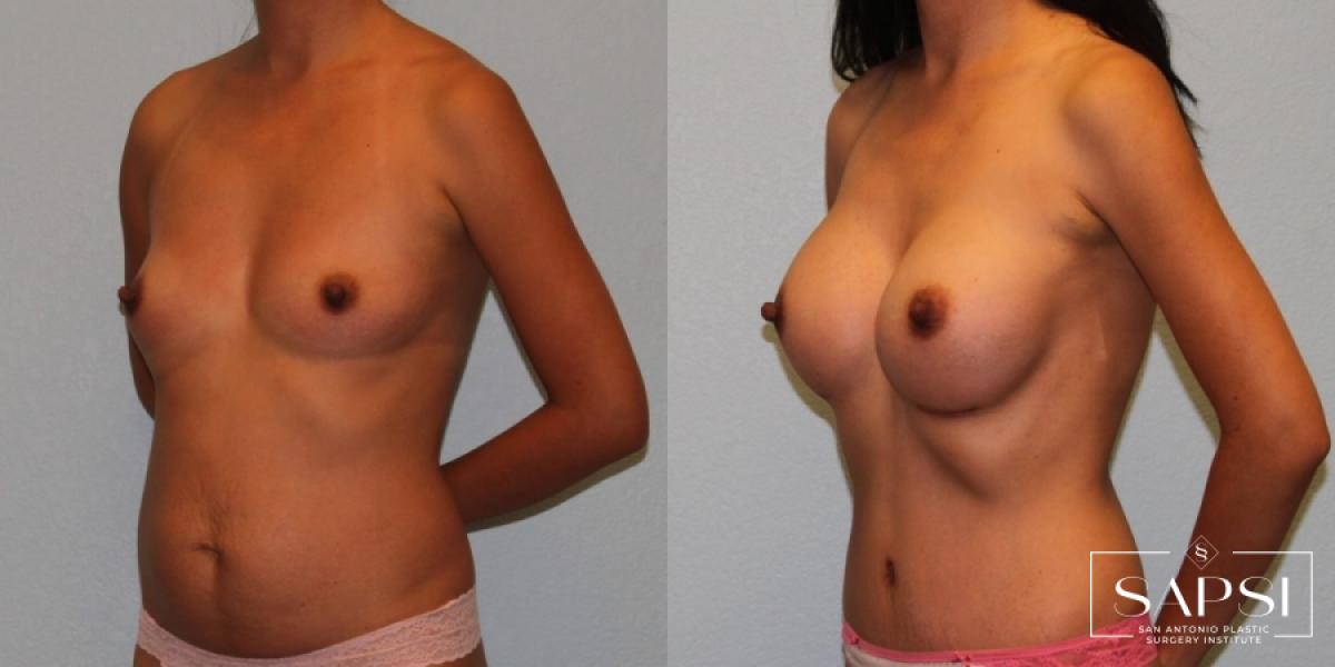 Tummy Tuck: Patient 45 - Before and After 2