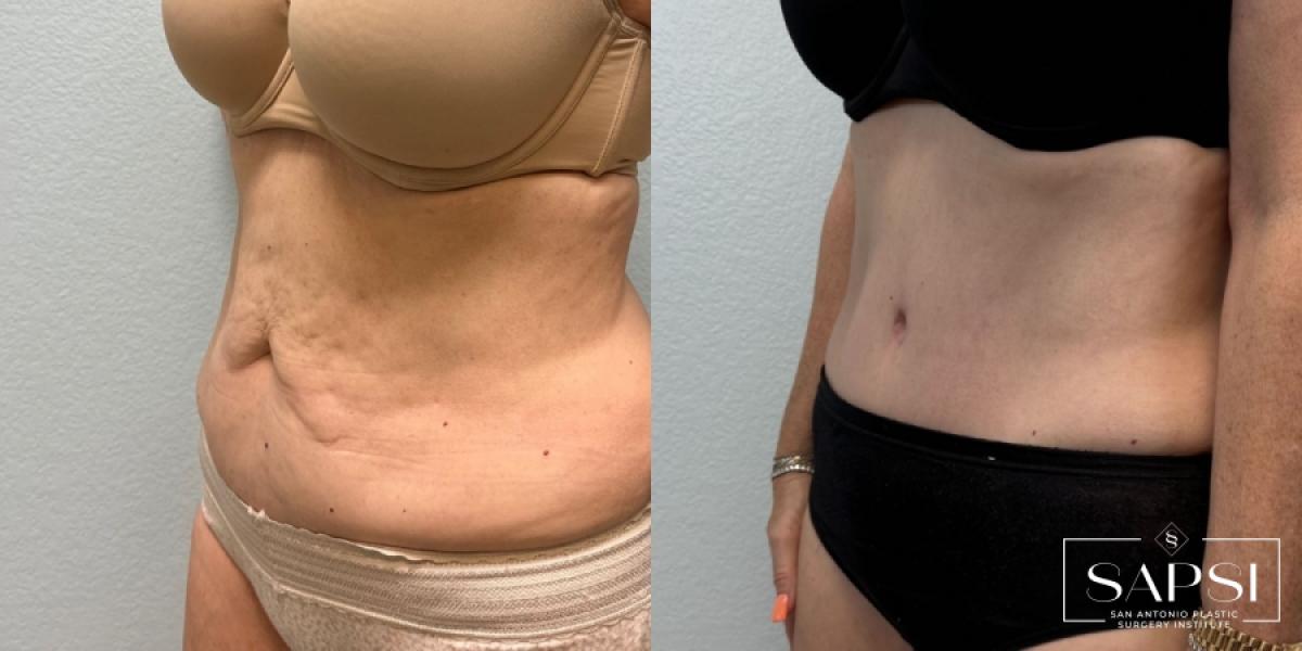 Tummy Tuck: Patient 4 - Before and After 2