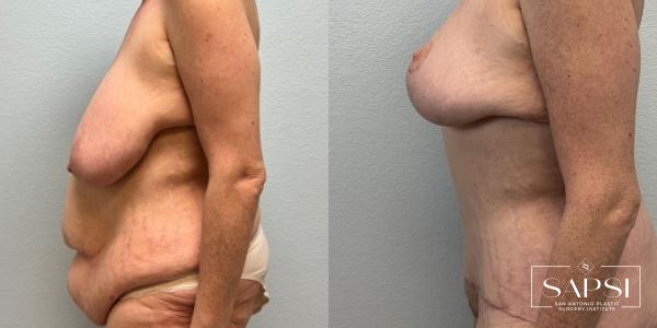 After Weight Loss: Patient 2 - Before and After 3